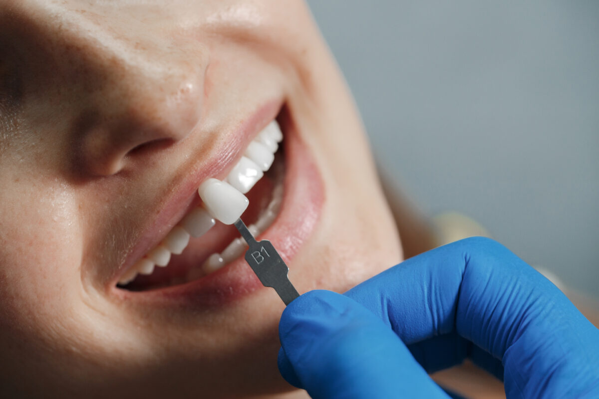 porcelain veneers in Irving TX